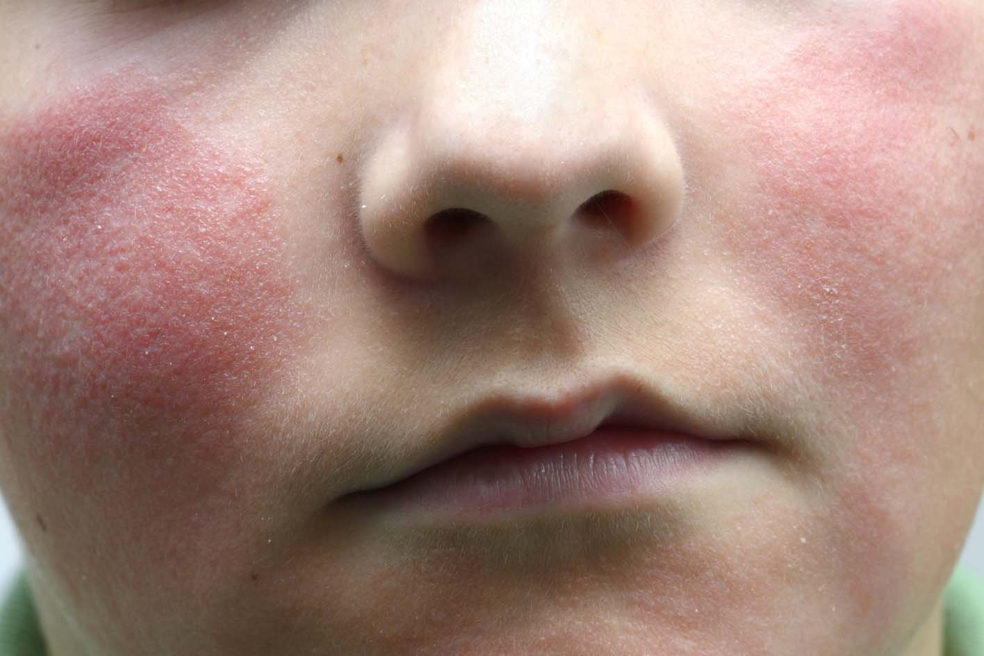 Rashes In Babies And Children NHS
