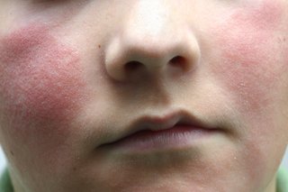 A child's face with a red rash on both cheeks. Shown on white skin.
