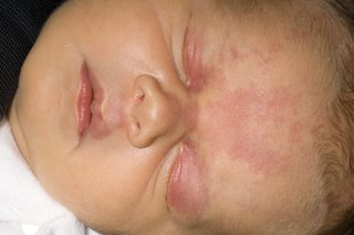 A baby's face with pink patches on their eyelids and forehead.