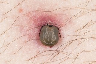 A tick shown burrowed into white skin. Only the body of the tick is visible and the skin around the tick is red.
