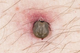 Close-up of a tick that has burrowed into a person's skin. The head of the tick is under the skin and the surrounding skin is red. Shown on white skin.