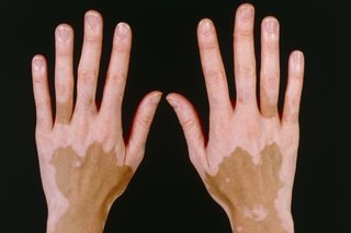 Picture of non-segmental vitiligo on brown skin