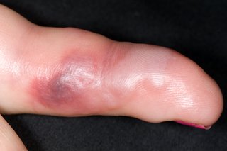 An infected sting on the finger or someone with white skin. The finger has raised patches that are white, red and purple.