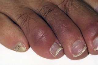 Chilblains on the toes of a person with dark brown skin. The tips of the toes are swollen and slightly red and purple.