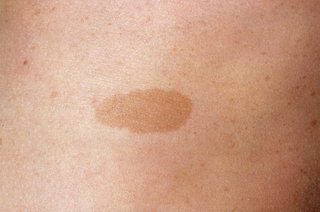 Close-up of a small, flat, light brown patch on white skin.