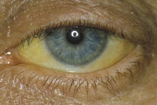 An eye, on someone with white skin, with a blue iris. The white part of the eye has turned yellow. The yellow is darker at the corners of the eye.