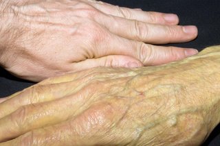 A white hand with skin looking yellow next to a white hand with no skin changes for comparison.