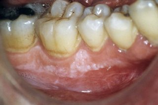 Close-up of a person's teeth and gums. There is a white patch on their gums, just below the teeth.