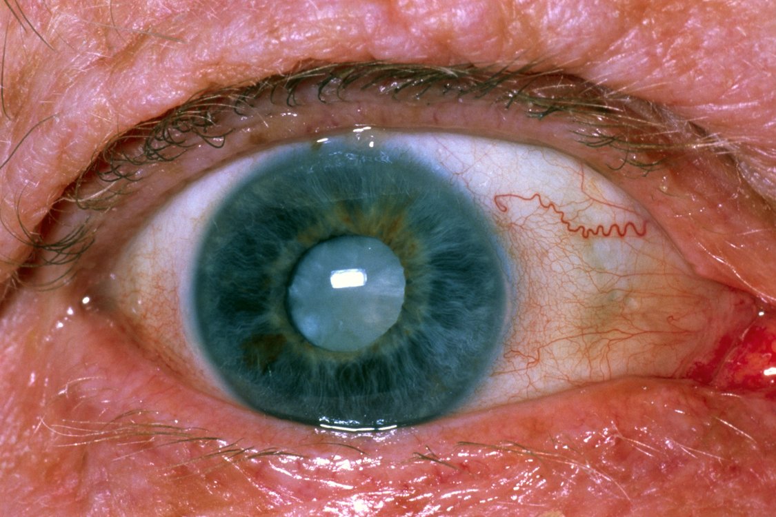 Agerelated cataracts NHS