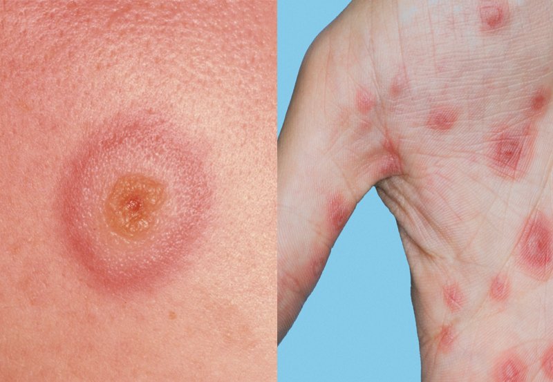 erythema-multiforme-nhs