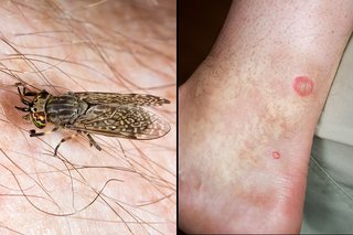 Horsefly bite