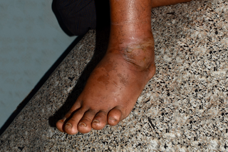A swollen ankle in someone with black skin. The ankle looks bigger than usual and is a darker colour than the skin surrounding it.