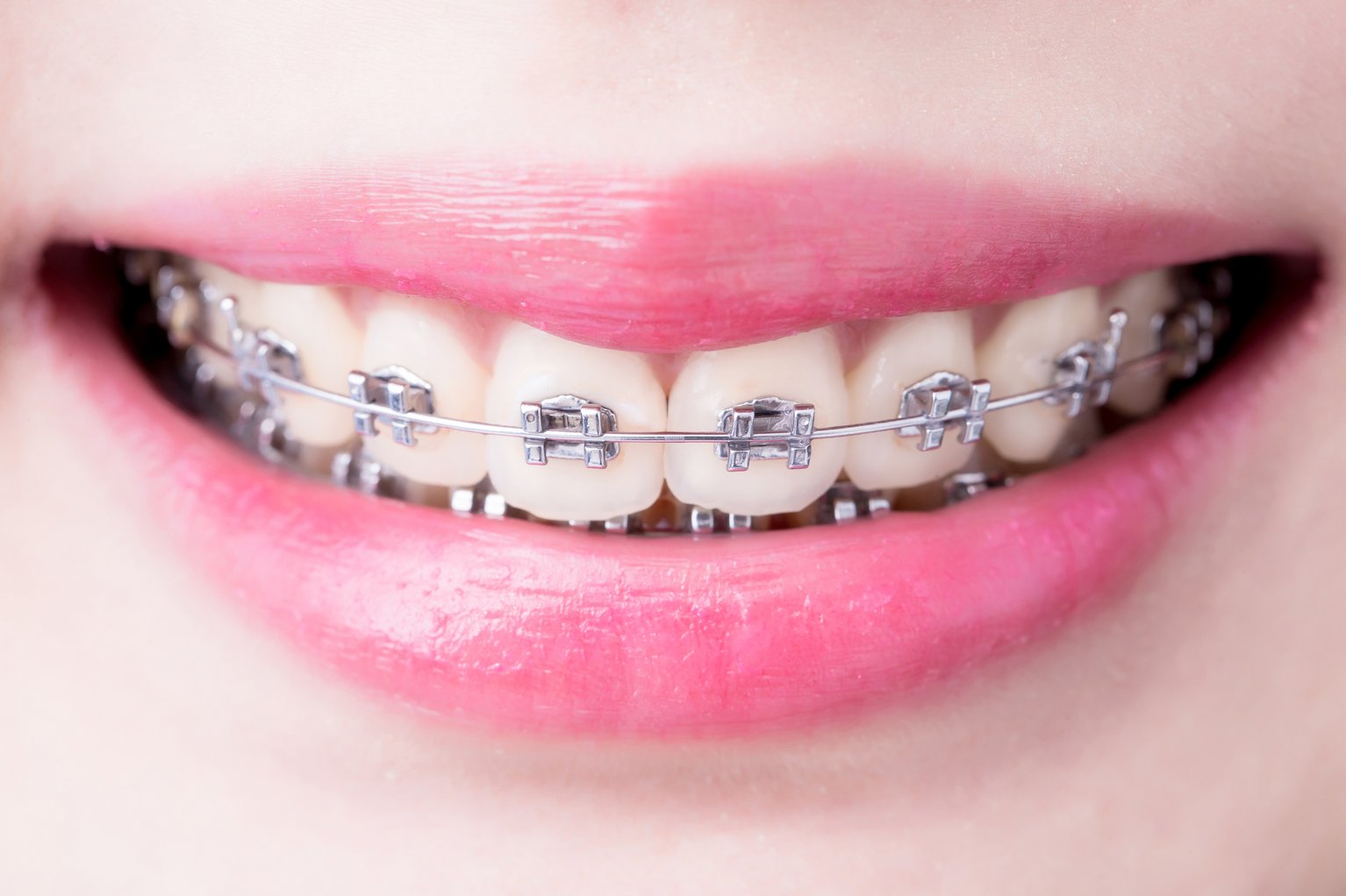 Braces and orthodontics NHS