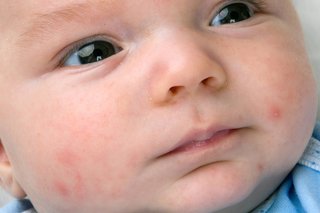A few small pink acne spots on a baby’s cheeks. Shown on white skin.