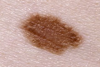 Symptoms Of Melanoma Nhs