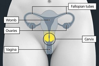 Diagram of the pelvic area with labels showing the vagina, cervix, womb, fallopian tubes and ovaries. The cervix is above the vagina.