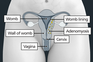 Diagram of the tummy area with labels showing the womb, wall of the womb and womb lining, the vagina and cervix. Small patches of adenomyosis are growing in the wall of the womb.