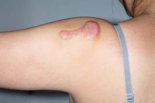 A keloid scar shown on white skin. There's a large, pink, raised scar on a person's shoulder.