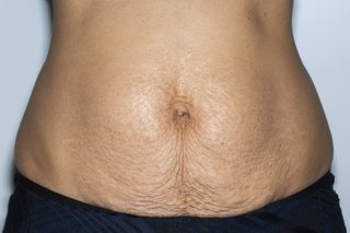 Close-up of a person’s tummy showing a number of creases in the skin under their belly button. The image shown is on light brown skin.