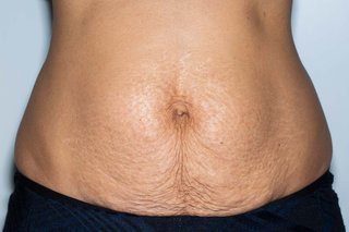 Stretch marks in pregnancy - NHS