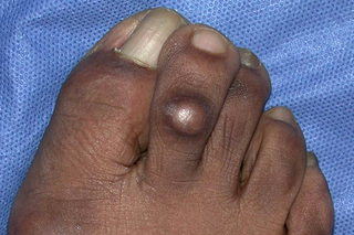 A corn on the toe of a person with dark brown skin. There's a small, round, skin-coloured lump with darker skin around it.