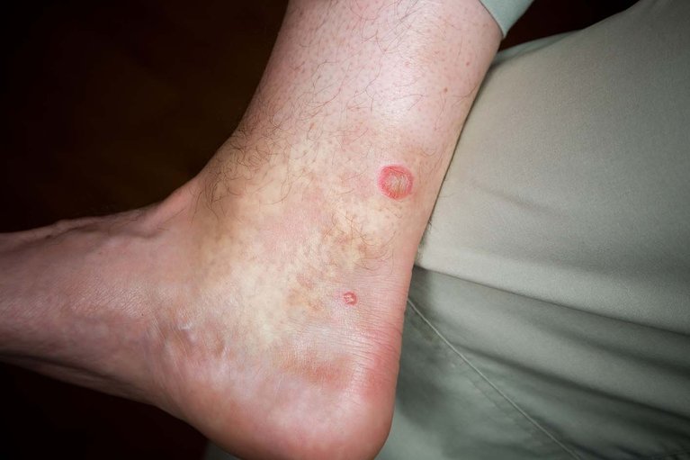 Insect bites and stings - NHS