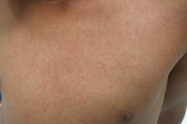 Scarlet fever rash: Symptoms, diagnosis, and treatment