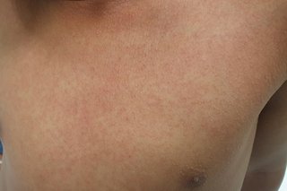 Rash of small, raised, pink spots spread across a child's chest. The spots are close together. The rash is shown on light brown skin.
