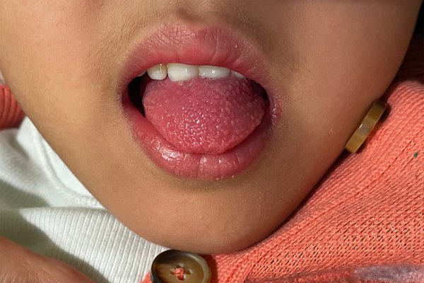 Scarlet fever outbreak fears: What are the symptoms, what treatment is  available and how is it spread?, The Independent