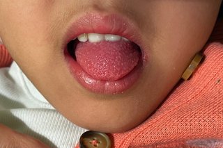 A young child with light brown skin sticking their tongue out. The tongue is red and covered in little bumps like a strawberry.
