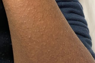 Rash of small, raised bumps spread across the lower part of a child's arm. The rash is shown on medium brown skin.