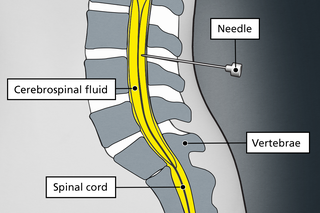 Diagram of a needle being inserted into the lower back, into a space inside the spine which contains fluid.