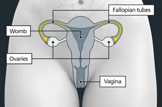 Diagram of the womb area with labels showing the vagina, womb, ovaries and fallopian tubes. The fallopian tubes are highlighted to show that they are blocked or cut during female sterilisation.