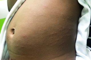 A rash with many small, raised bumps, on a child's tummy. Shown on black skin.