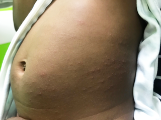A rash with many small, raised bumps, on a child's tummy. Shown on black skin.