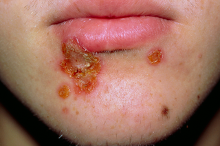 3 patches of crusty, light-brown skin on a person’s chin from impetigo. They have a large, crusty patch underneath their lower lip. Shown on white skin.