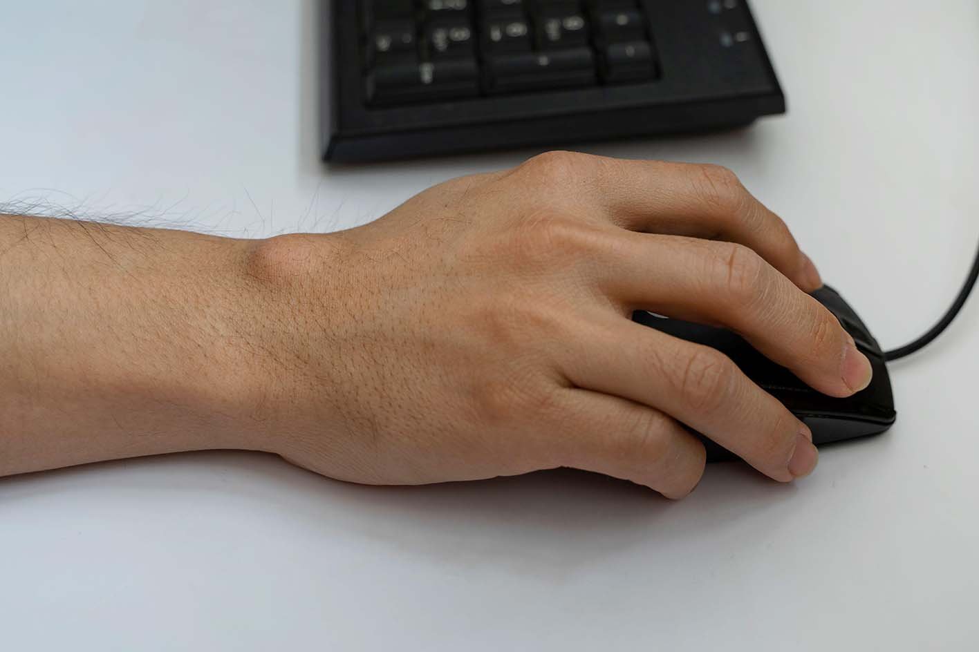 Computer Mouse Cyst Ganglion cyst - NHS
