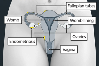 Diagram of the womb area, showing the womb, womb lining, vagina, ovaries and fallopian tubes. There are small patches of endometriosis on the ovaries, fallopian tubes and the outside of the womb.