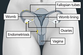 Diagram of the womb area, showing the womb, womb lining, vagina, ovaries and fallopian tubes. There are small patches of endometriosis on the ovaries, fallopian tubes and the outside of the womb.