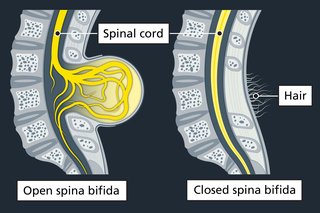 Two spines with spina bifida. One with open spina bifida, where the spinal cord has grown out of a gap in the spine. The other is closed spina bifida where there is a gap in the spine and a small tuft of hair is growing out of the skin covering the gap.