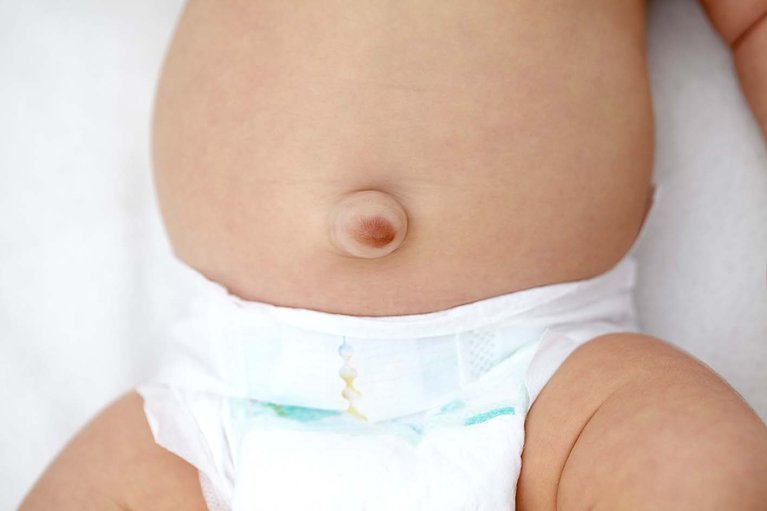 umbilical-hernia-nhs