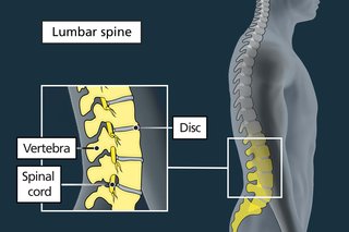 Illustration of the spine with the lower part (lumbar vertebrae) in yellow. On the left is a detailed illustration of bones (vertebrae) and nerves (spinal cord).