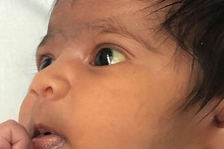 Baby with brown skin. The whites of the baby’s eyes look yellow.