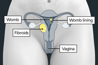 Diagram of the pelvic area with labels showing the womb and vagina, with fibroids growing in and around the womb.