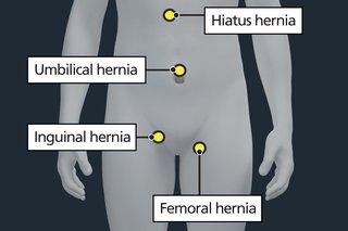 An illustration of a person's abdomen and thighs, with yellow dots and labels indicating the location of common types of hernia.