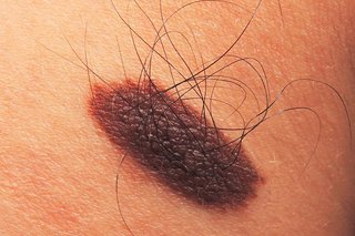 A harmless, raised, dark brown mole with hairs growing from it on white skin.