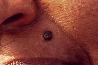 A harmless, black mole on the upper lip of someone with medium brown skin.