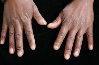 Hands of a person with dark brown skin. The fingertips around the nails are paler than the rest of the skin.