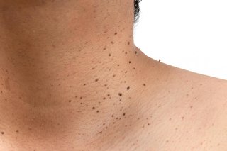 Multiple skin tags on the neck of a person with light brown skin.