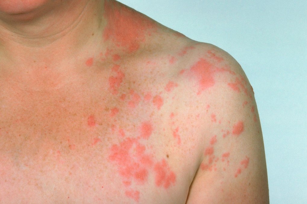 does shingles itch